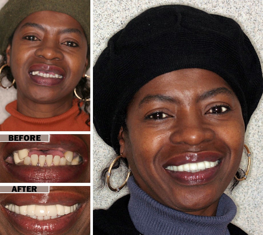 Veneer Dentures Hunters WA 99137